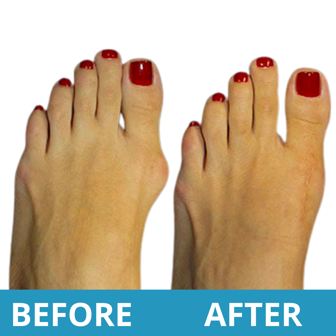 Women Bunion Correction Sandals