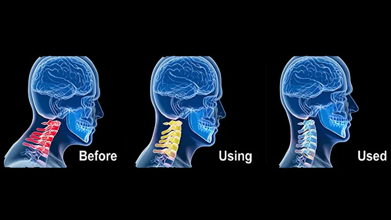 Orthopedic Cervical Strecher I Eliminate neck pain in just 10 minutes a day!